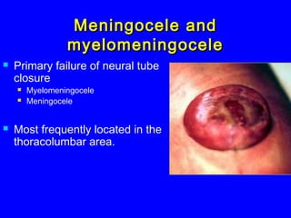 Meningocele andMeningocele and
myelomeningocelemyelomeningocele
 Primary failure of neural tube
closure
 Myelomeningocele
 Meningocele
 Most frequently located in the
thoracolumbar area.
 