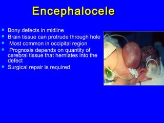 EncephaloceleEncephalocele
 Bony defects in midline
 Brain tissue can protrude through hole
 Most common in occipital region
 Prognosis depends on quantity of
cerebral tissue that herniates into the
defect
 Surgical repair is required
 