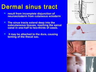 Dermal sinus tractDermal sinus tract
 result from incomplete disjunction of
neuroectoderm from cutaneous ectoderm
 The sinus tracts extend deep into the
subcutaneous tissues, reaching the spinal
canal in one-half to two-thirds of cases.
 it may be attached to the dura, causing
tenting of the thecal sac.
 