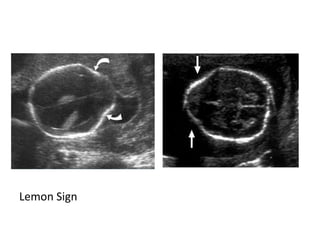 Diagnostic Imaging of Congenital Central Nervous System Diseases | PPT