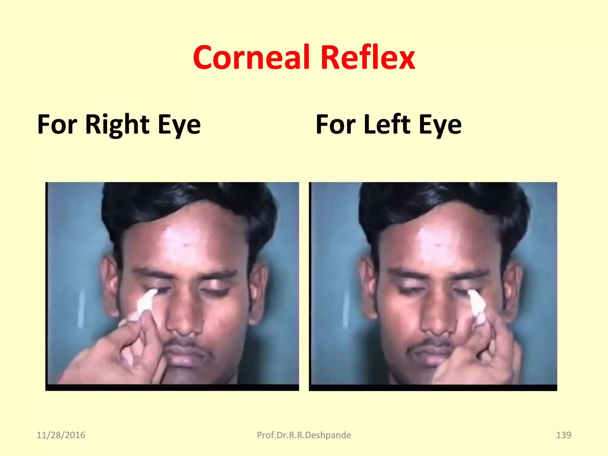 Corneal Reflex
For Right Eye For Left Eye
11/28/2016 Prof.Dr.R.R.Deshpande 139
 