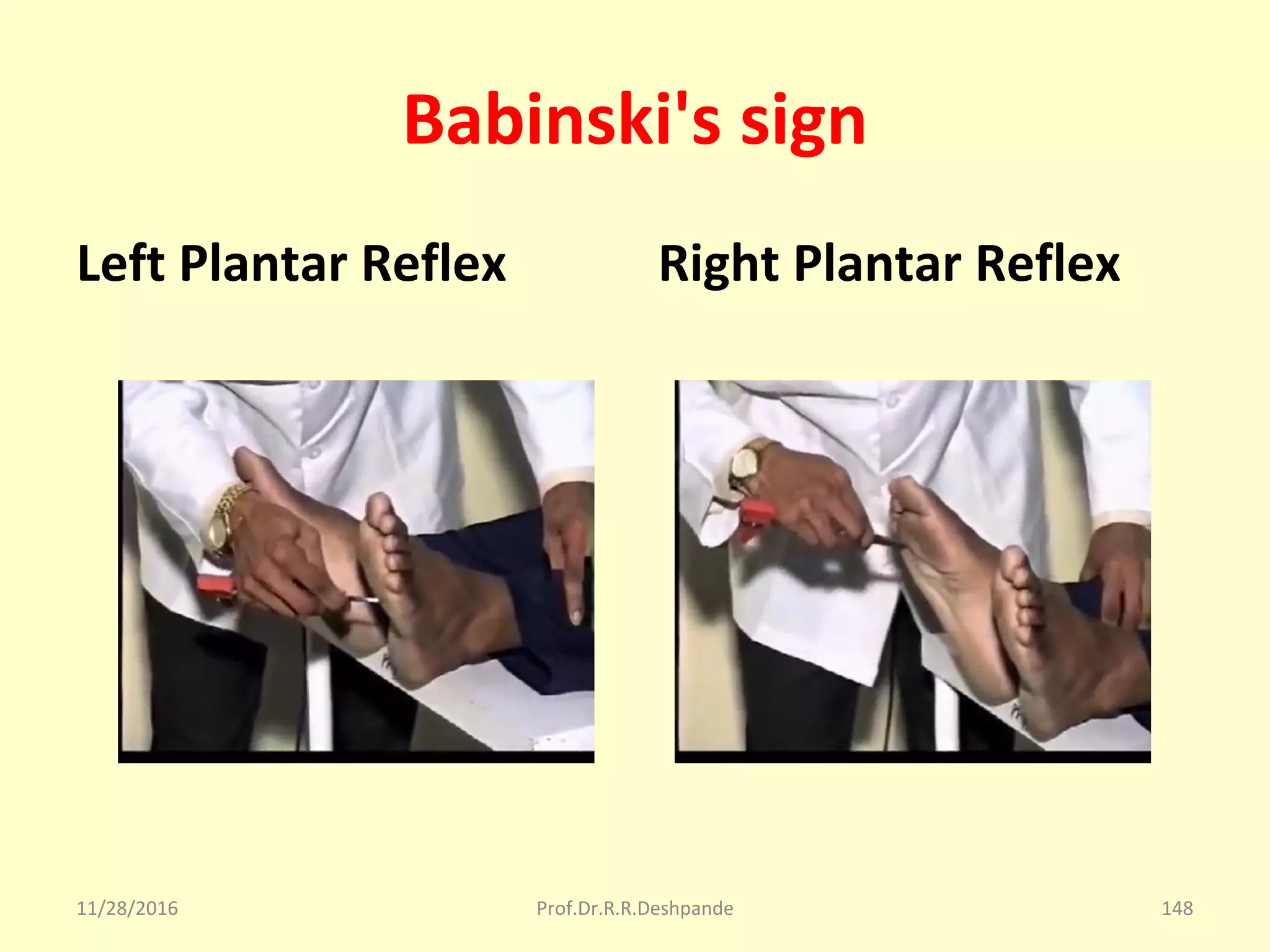 Babinski's sign
Left Plantar Reflex Right Plantar Reflex
11/28/2016 Prof.Dr.R.R.Deshpande 148
 