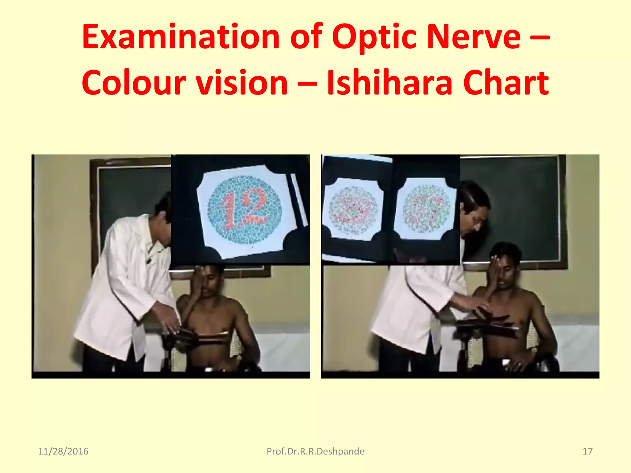 Examination of Optic Nerve –
Colour vision – Ishihara Chart
11/28/2016 Prof.Dr.R.R.Deshpande 17
 