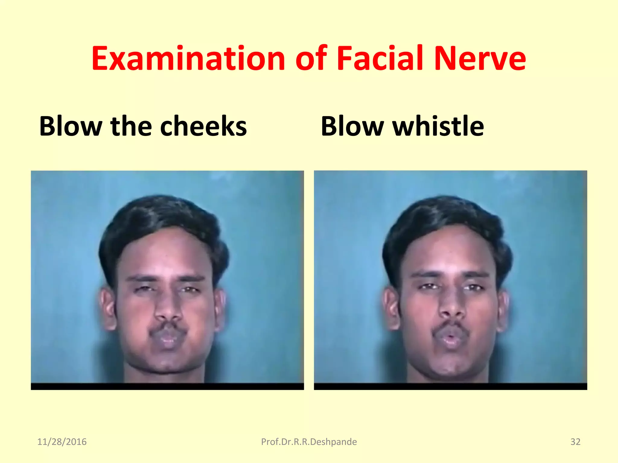 Examination of Facial Nerve
Blow the cheeks Blow whistle
11/28/2016 Prof.Dr.R.R.Deshpande 32
 