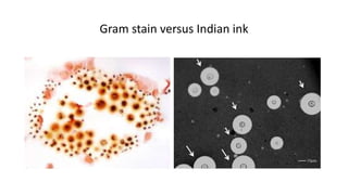 What Is Ink Infection Central Nervous System Fungal Infection | PPTX