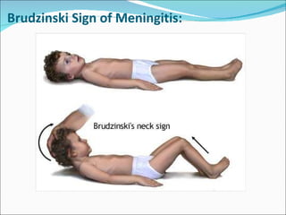 Brudzinski Sign of Meningitis: 