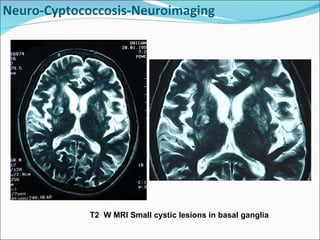 Neuro-Cyptococcosis-Neuroimaging T2  W MRI Small cystic lesions in basal ganglia  