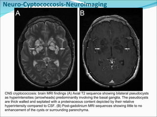 CNS cryptococcosis: brain MRI findings (A) Axial T2 sequence showing bilateral pseudocysts as hyperintensities (arrowheads) predominantly involving the basal ganglia. The pseudocysts are thick walled and septated with a proteinaceous content depicted by their relative hyperintensity compared to CSF. (B) Post-gadolinium MRI sequences showing little to no enhancement of the cysts or surrounding parenchyma. Neuro-Cyptococcosis-Neuroimaging 
