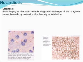 Nocardiosis Diagnosis Brain biopsy is the most reliable diagnostic technique if the diagnosis cannot be made by evaluation of pulmonary or skin lesion. 