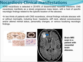 Nocardiosis-Clinical manifestations  CNS nocardiosis is detected in 20-40% of disseminated nocardial infections. CNS nocardiosis manifests as a slowly progressive mass lesion, with a host of specific neurologic findings related to the specific location of the abscess. In two thirds of patients with CNS nocardiosis, clinical findings indicate abscess with or without meningitis, including fever, headache, stiff neck, altered consciousness and/or altered mental status, personality changes, or various localizing neurologic findings. Brain MRI scan in a patient with nocardial brain abscess. 