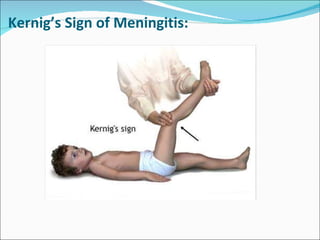 Kernig’s Sign of Meningitis: 