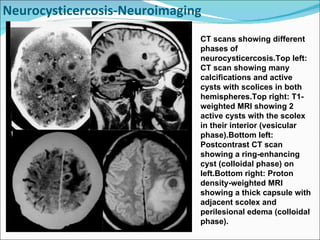 Neurocysticercosis-Neuroimaging  CT scans showing different phases of neurocysticercosis.Top left: CT scan showing many calcifications and active cysts with scolices in both hemispheres.Top right: T1-weighted MRI showing 2 active cysts with the scolex in their interior (vesicular phase).Bottom left: Postcontrast CT scan showing a ring-enhancing cyst (colloidal phase) on left.Bottom right: Proton density-weighted MRI showing a thick capsule with adjacent scolex and perilesional edema (colloidal phase). 