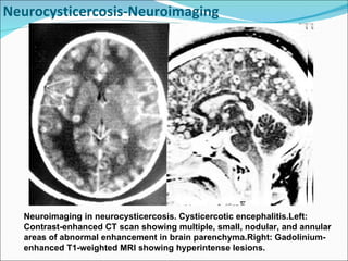 Neurocysticercosis-Neuroimaging Neuroimaging in neurocysticercosis. Cysticercotic encephalitis.Left: Contrast-enhanced CT scan showing multiple, small, nodular, and annular areas of abnormal enhancement in brain parenchyma.Right: Gadolinium-enhanced T1-weighted MRI showing hyperintense lesions. 