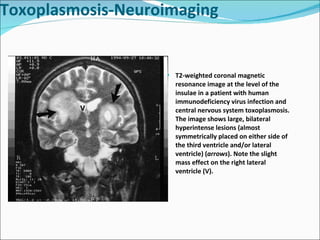 T2-weighted coronal magnetic resonance image at the level of the insulae in a patient with human immunodeficiency virus infection and central nervous system toxoplasmosis. The image shows large, bilateral hyperintense lesions (almost symmetrically placed on either side of the third ventricle and/or lateral ventricle) ( arrows ). Note the slight mass effect on the right lateral ventricle (V). Toxoplasmosis-Neuroimaging 