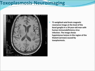 T1-weighted axial brain magnetic resonance image at the level of the basal ganglia in a 24-year-old man with human immunodeficiency virus infection. The image shows hypointense lesions in the region of the thalami ( arrows ) caused by toxoplasmosis. Toxoplasmosis-Neuroimaging 