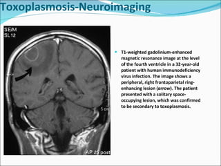 T1-weighted gadolinium-enhanced magnetic resonance image at the level of the fourth ventricle in a 32-year-old patient with human immunodeficiency virus infection. The image shows a peripheral, right frontoparietal ring-enhancing lesion ( arrow ). The patient presented with a solitary space-occupying lesion, which was confirmed to be secondary to toxoplasmosis. Toxoplasmosis-Neuroimaging 