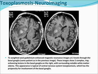 T1-weighted axial gadolinium-enhanced magnetic resonance images at 2 levels through the basal ganglia (same patient as in the previous image). These images show 2 complex, ring-enhancing lesions in the basal ganglia on the right, with surrounding notable white matter edema. This appearance is typical of central nervous system toxoplasmosis, which has the propensity for involvement of the basal ganglia. Toxoplasmosis-Neuroimaging 