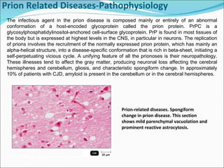 Prion Related Diseases-Pathophysiology      The infectious agent in the prion disease is composed mainly or entirely of an abnormal conformation of a host-encoded glycoprotein called the prion protein. PrPC is a glycosylphosphatidylinositol-anchored cell-surface glycoprotein. PrP is found in most tissues of the body but is expressed at highest levels in the CNS, in particular in neurons. The replication of prions involves the recruitment of the normally expressed prion protein, which has mainly an alpha-helical structure, into a disease-specific conformation that is rich in beta-sheet, initiating a self-perpetuating vicious cycle. A unifying feature of all the prionoses is their neuropathology. These illnesses tend to affect the gray matter, producing neuronal loss affecting the cerebral hemispheres and cerebellum, gliosis, and characteristic spongiform change. In approximately 10% of patients with CJD, amyloid is present in the cerebellum or in the cerebral hemispheres.  Prion-related diseases. Spongiform change in prion disease. This section shows mild parenchymal vacuolation and prominent reactive astrocytosis. 