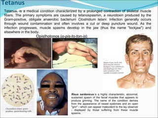 Tetanus Tetanus, is a medical condition characterized by a prolonged contraction of skeletal muscle fibers. The primary symptoms are caused by tetanospasmin, a neurotoxin produced by the Gram-positive, obligate anaerobic bacterium  Clostridium tetani.  Infection generally occurs through wound contamination and often involves a cut or deep puncture wound. As the infection progresses, muscle spasms develop in the jaw (thus the name "lockjaw") and elsewhere in the body.  Risus sardonicus  is a highly characteristic, abnormal, sustained spasm of the facial muscles that appears to produce grinning. The name of the condition derives from the appearance of raised eyebrows and an open "grin" - which can appear malevolent to the lay observer - displayed by those suffering from these muscle spasms. Opisthotonos ( o-pis-to-ton-is ) 