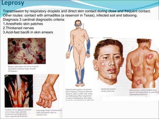 Leprosy Transmission by respiratory droplets and direct skin contact during close and frequent contact. Other routes: contact with armadillos (a reservoir in Texas), infected soil and tattooing. Diagnosis 3 cardinal diagnositic criteria: 1.Anesthetic skin patches 2.Thinkened nerves 3.Acid-fast bacilli in skin smears 