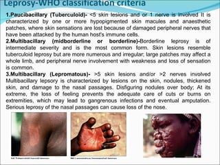 Leprosy-WHO classification criteria 1.Paucibacillary ( Tuberculoid)-  <5 skin lesions and or 1 nerve is involved It is characterized by one or more hypopigmented skin macules and anaesthetic patches, where skin sensations are lost because of damaged peripheral nerves that have been attacked by the human host's immune cells. 2.Multibacillary (midborderline or borderline)- Borderline leprosy is of intermediate severity and is the most common form. Skin lesions resemble tuberculoid leprosy but are more numerous and irregular; large patches may affect a whole limb, and peripheral nerve involvement with weakness and loss of sensation is common.  3.Multibacillary (Lepromatous)-  >5 skin lesions and/or >2 nerves involved Multibacillary lepsory is characterized by lesions on the skin, nodules, thickened skin, and damage to the nasal passages. Disfiguring nodules over body; At its extreme, the loss of feeling prevents the adequate care of cuts or burns on extremities, which may lead to gangrenous infections and eventual amputation. Serious leprosy of the nasal passages can cause loss of the nose. 