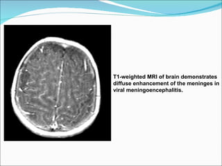 T1-weighted MRI of brain demonstrates diffuse enhancement of the meninges in viral meningoencephalitis. 