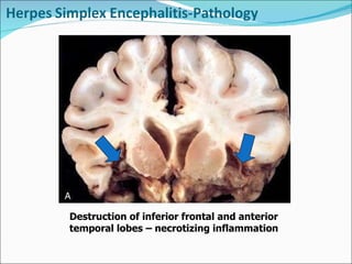 Destruction of inferior frontal and anterior temporal lobes – necrotizing inflammation 