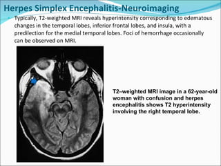 Herpes Simplex Encephalitis-Neuroimaging Typically, T2-weighted MRI reveals hyperintensity corresponding to edematous changes in the temporal lobes, inferior frontal lobes, and insula, with a predilection for the medial temporal lobes. Foci of hemorrhage occasionally can be observed on MRI. T2–weighted MRI image in a 62-year-old woman with confusion and herpes encephalitis shows T2 hyperintensity involving the right temporal lobe. 