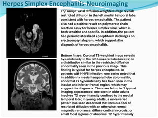 Top Image:  Axial diffusion-weighted image reveals restricted diffusion in the left medial temporal lobe consistent with herpes encephalitis. This patient also had a positive result on polymerase chain reaction assay for herpes simplex virus, which is both sensitive and specific. In addition, the patient had periodic lateralized epileptiform discharges on electroencephalogram, which supports the diagnosis of herpes encephalitis. Bottom Image:  Coronal T2-weighted image reveals hyperintensity in the left temporal lobe ( arrows ) in a distribution similar to the restricted diffusion abnormality seen in the previous image. This finding is typical for herpes encephalitis. In patients with HHV6 infection, one series noted that in addition to mesial temporal lobe abnormality, abnormal T2 hyperintensity has been seen in the insular and inferior frontal region, which may suggest the diagnosis. There are felt to be 2 typical imaging appearances: one seen in older adults involves T2 hyperintensity confined to the medial temporal lobe; in young adults, a more varied pattern has been described that includes foci of restricted diffusion with an otherwise normal magnetic resonance, diffuse cortical necrosis, or small focal regions of abnormal T2 hyperintensity. 