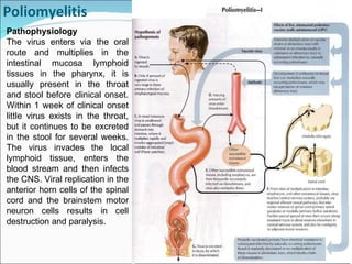 Poliomyelitis Pathophysiology The virus enters via the oral route and multiplies in the intestinal mucosa lymphoid tissues in the pharynx, it is usually present in the throat and stool before clinical onset. Within 1 week of clinical onset little virus exists in the throat, but it continues to be excreted in the stool for several weeks. The virus invades the local lymphoid tissue, enters the blood stream and then infects the CNS. Viral replication in the anterior horn cells of the spinal cord and the brainstem motor neuron cells results in cell destruction and paralysis. 