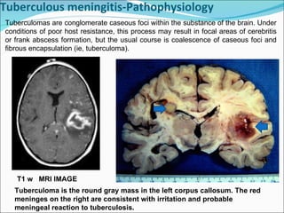 Tuberculous meningitis-Pathophysiology T1 w  MRI IMAGE Tuberculoma is the round gray mass in the left corpus callosum. The red meninges on the right are consistent with irritation and probable meningeal reaction to tuberculosis. Tuberculomas are conglomerate caseous foci within the substance of the brain. Under conditions of poor host resistance, this process may result in focal areas of cerebritis or frank abscess formation, but the usual course is coalescence of caseous foci and fibrous encapsulation (ie, tuberculoma).  