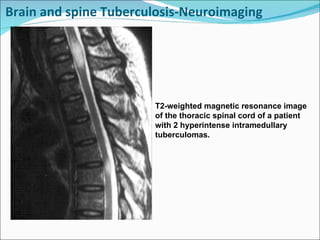 Brain and spine Tuberculosis-Neuroimaging T2-weighted magnetic resonance image of the thoracic spinal cord of a patient with 2 hyperintense intramedullary tuberculomas. 