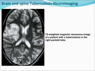 Brain and spine Tuberculosis-Neuroimaging T2-weighted magnetic resonance image of a patient with a tuberculoma in the right parietal lobe. 