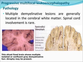 Progressive multifocal leukoencephalopathy  Pathology  Multiple demyelinative lesions are generally located in the cerebral white matter. Spinal cord involvement is rare. This sliced fixed brain shows multiple isolated or confluent gray demyelinative foci. Atrophy may be present.  