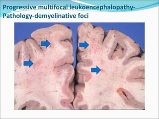 Progressive multifocal leukoencephalopathy-Pathology-demyelinative foci 