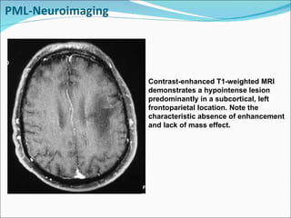 PML-Neuroimaging Contrast-enhanced T1-weighted MRI demonstrates a hypointense lesion predominantly in a subcortical, left frontoparietal location. Note the characteristic absence of enhancement and lack of mass effect. 