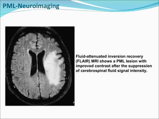 PML-Neuroimaging Fluid-attenuated inversion recovery (FLAIR) MRI shows a PML lesion with improved contrast after the suppression of cerebrospinal fluid signal intensity. 