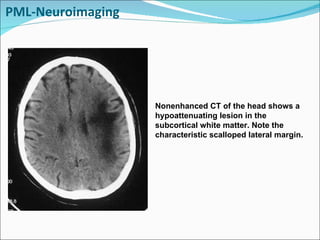 PML-Neuroimaging Nonenhanced CT of the head shows a hypoattenuating lesion in the subcortical white matter. Note the characteristic scalloped lateral margin. 