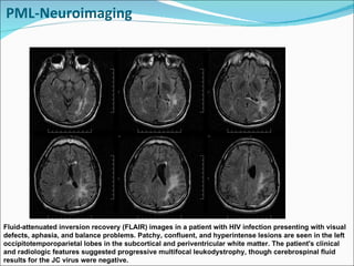 PML-Neuroimaging Fluid-attenuated inversion recovery (FLAIR) images in a patient with HIV infection presenting with visual defects, aphasia, and balance problems. Patchy, confluent, and hyperintense lesions are seen in the left occipitotemporoparietal lobes in the subcortical and periventricular white matter. The patient's clinical and radiologic features suggested progressive multifocal leukodystrophy, though cerebrospinal fluid results for the JC virus were negative. 