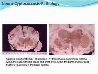 Neuro-Cyptococcosis-Pathology Opaque thick fibrotic CSF obstruction - hydrocephalus. Gelatinous material within the subarachnoid space and small cysts within the parenchyma ("soap bubbles“) Specially in the basal ganglia. 