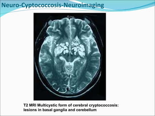 Neuro-Cyptococcosis-Neuroimaging T2 MRI Multicystic form of cerebral cryptococcosis: lesions in basal ganglia and cerebellum  