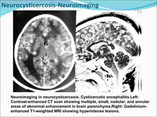 Cns infections Lecture Slide 121