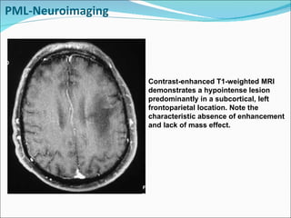 Cns infections Lecture Slide 88