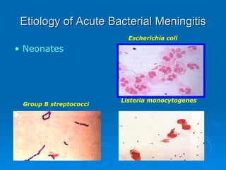 Etiology of Acute Bacterial Meningitis Escherichia coli Group B streptococci Neonates Listeria monocytogenes 