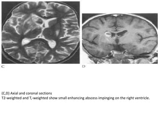 Cns infections Slide 48