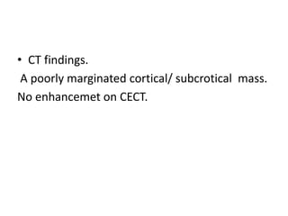 • CT findings.
A poorly marginated cortical/ subcrotical mass.
No enhancemet on CECT.
 