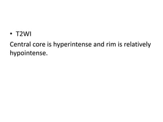• T2WI
Central core is hyperintense and rim is relatively
hypointense.
 