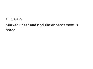 • T1 C+FS
Marked linear and nodular enhancement is
noted.
 