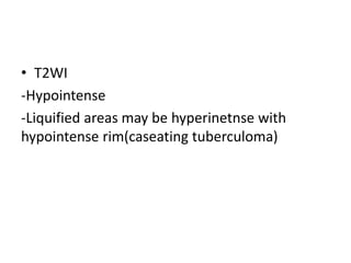 • T2WI
-Hypointense
-Liquified areas may be hyperinetnse with
hypointense rim(caseating tuberculoma)
 