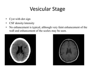 Vesicular Stage
• Cyst with dot sign
• CSF density/intensity
• No enhancement is typical, although very faint enhancement of the
wall and enhancement of the scolex may be seen.
 